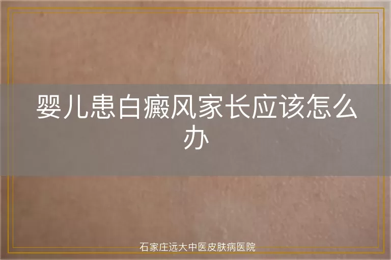 婴儿患白癜风家长应该怎么办