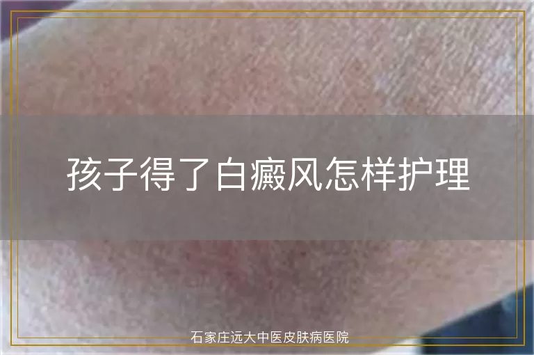 孩子得了白癜风怎样护理