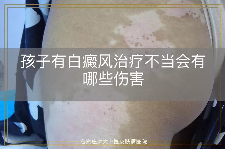 孩子有白癜风治疗不当会有哪些伤害