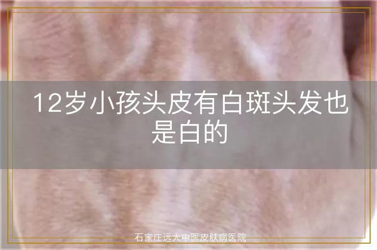 12岁小孩头皮有白斑头发也是白的