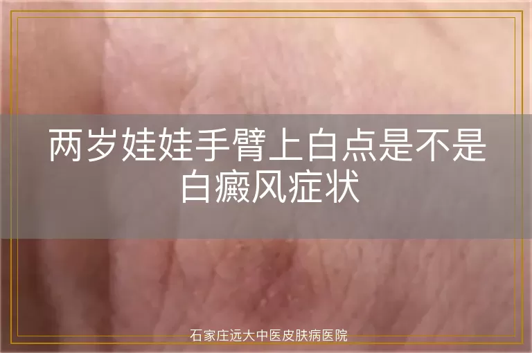 两岁娃娃手臂上白点是不是白癜风症状