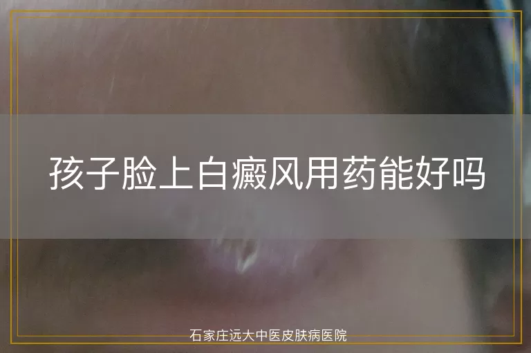 孩子脸上白癜风用药能好吗