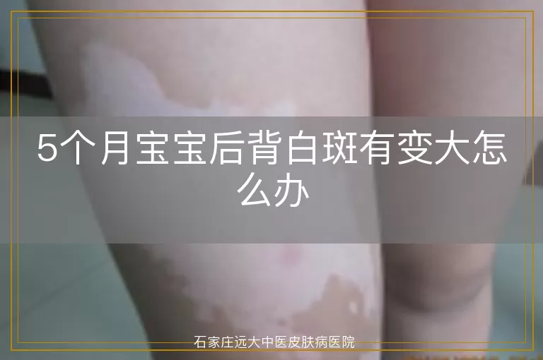 5个月宝宝后背白斑有变大怎么办