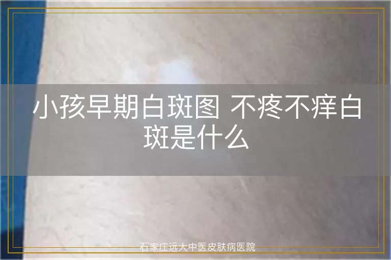 小孩早期白斑图 不疼不痒白斑是什么