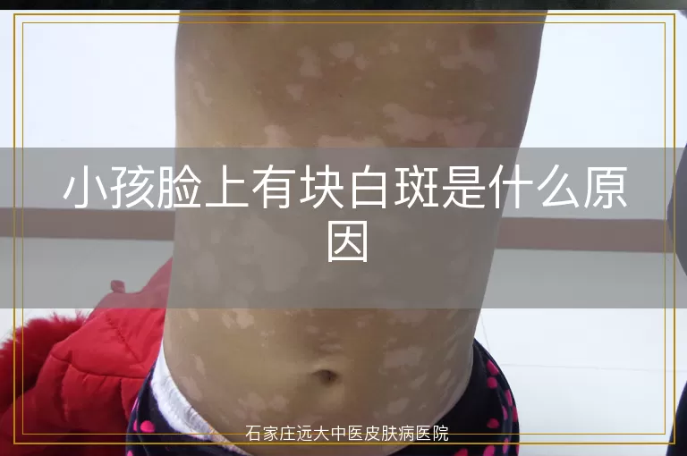 小孩脸上有块白斑是什么原因