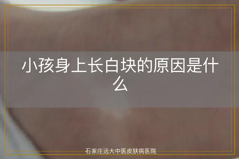 小孩身上长白块的原因是什么