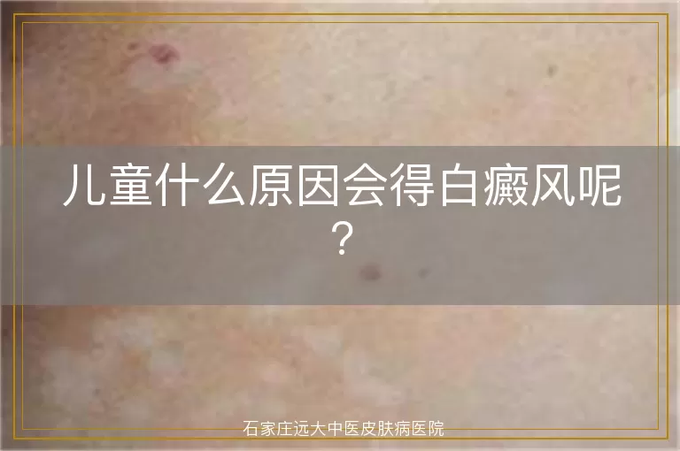 儿童什么原因会得白癜风呢?