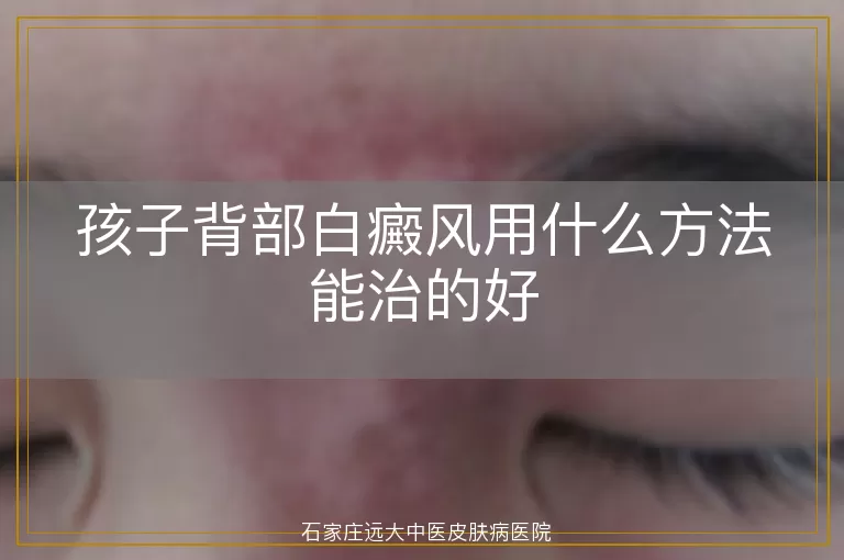 孩子背部白癜风用什么方法能治的好
