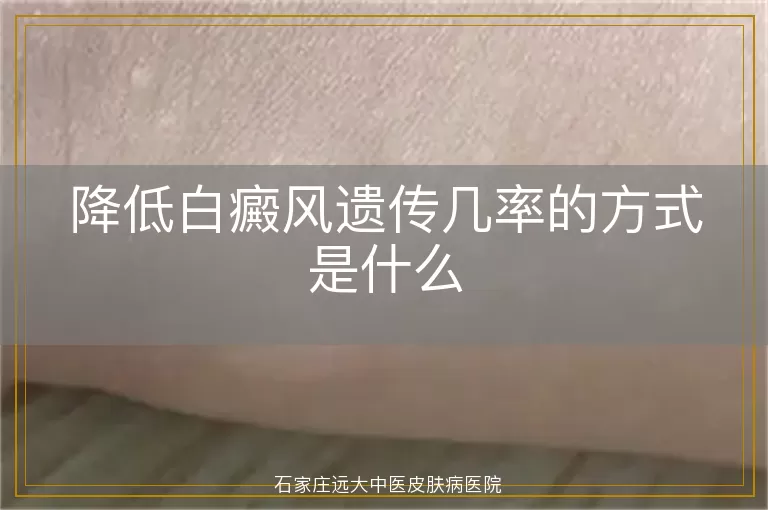 降低白癜风遗传几率的方式是什么