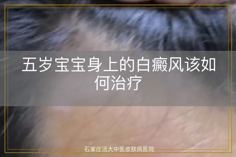 五岁宝宝身上的白癜风该如何治疗