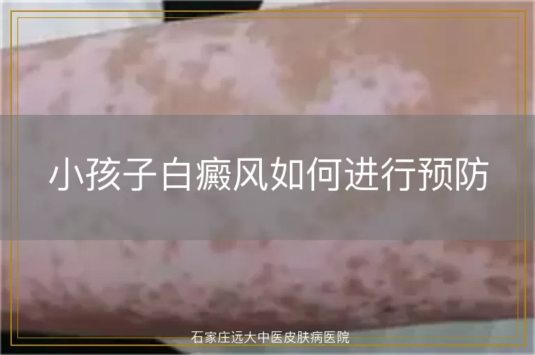 小孩子白癜风如何进行预防