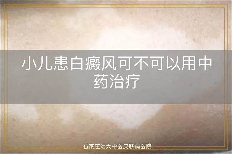小儿患白癜风可不可以用中药治疗