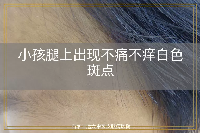 小孩腿上出现不痛不痒白色斑点
