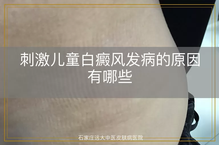 刺激儿童白癜风发病的原因有哪些