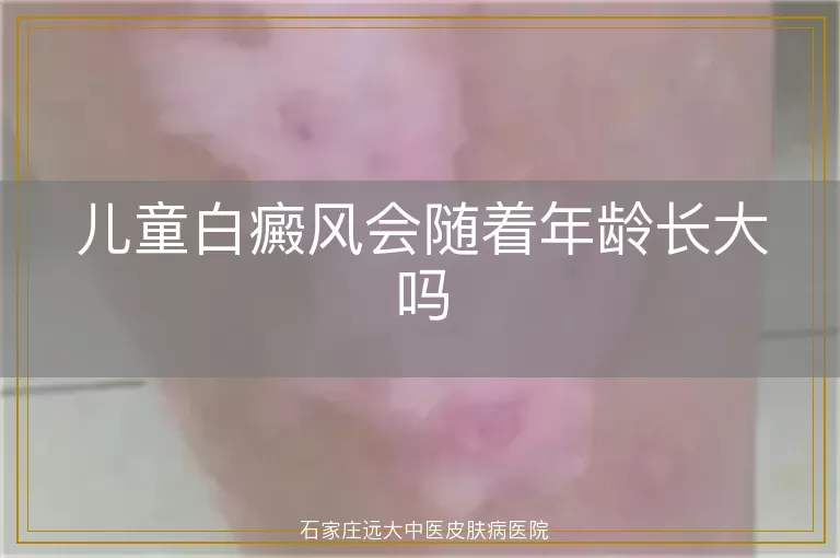 儿童白癜风会随着年龄长大吗