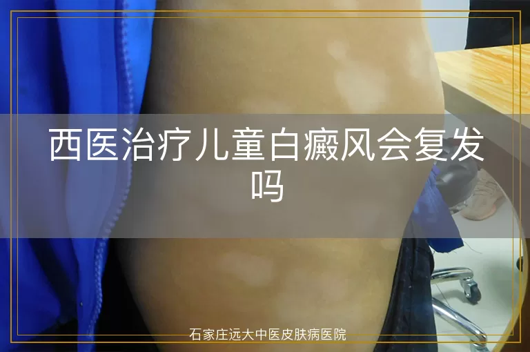 西医治疗儿童白癜风会复发吗