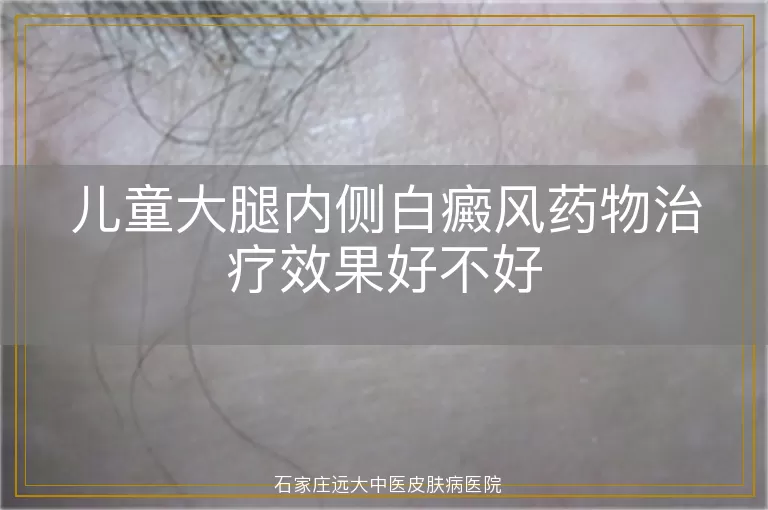 儿童大腿内侧白癜风药物治疗效果好不好