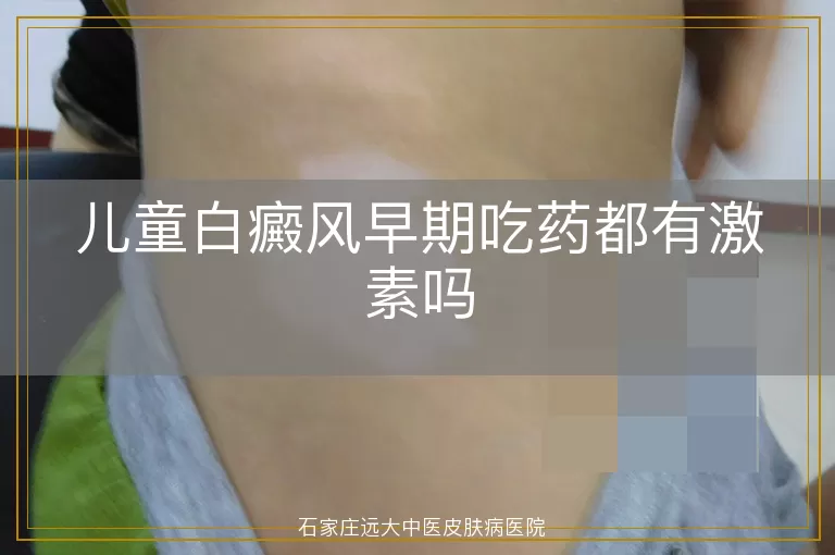 儿童白癜风早期吃药都有激素吗