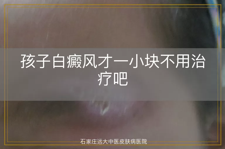 孩子白癜风才一小块不用治疗吧