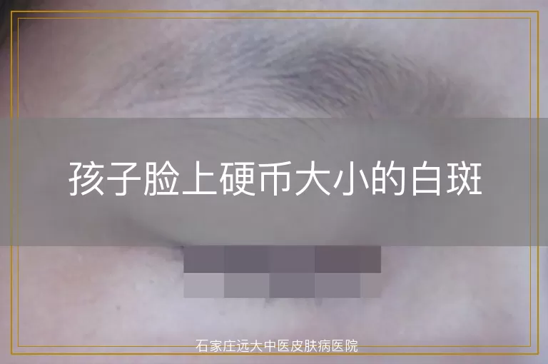 孩子脸上硬币大小的白斑