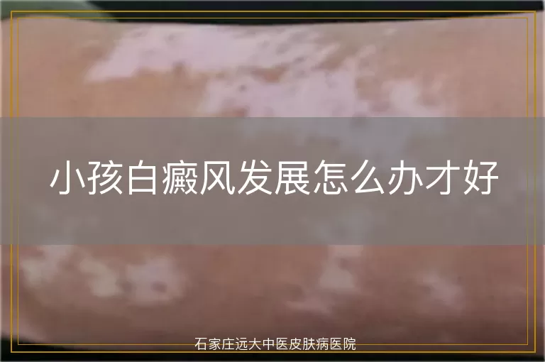 小孩白癜风发展怎么办才好