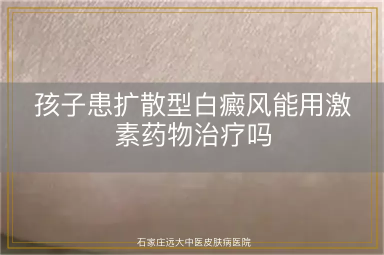 孩子患扩散型白癜风能用激素药物治疗吗
