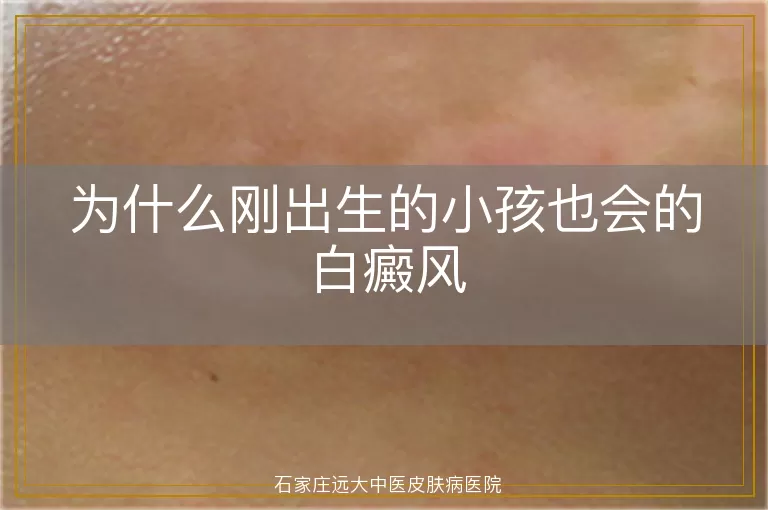 为什么刚出生的小孩也会的白癜风