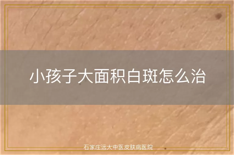 小孩子大面积白斑怎么治