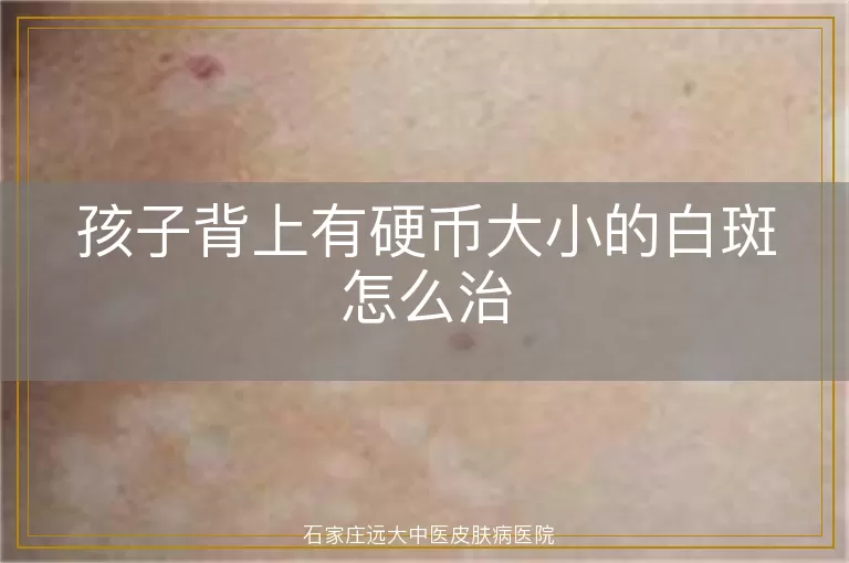 孩子背上有硬币大小的白斑怎么治