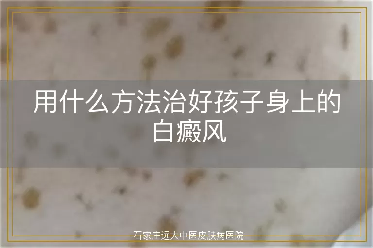 用什么方法治好孩子身上的白癜风