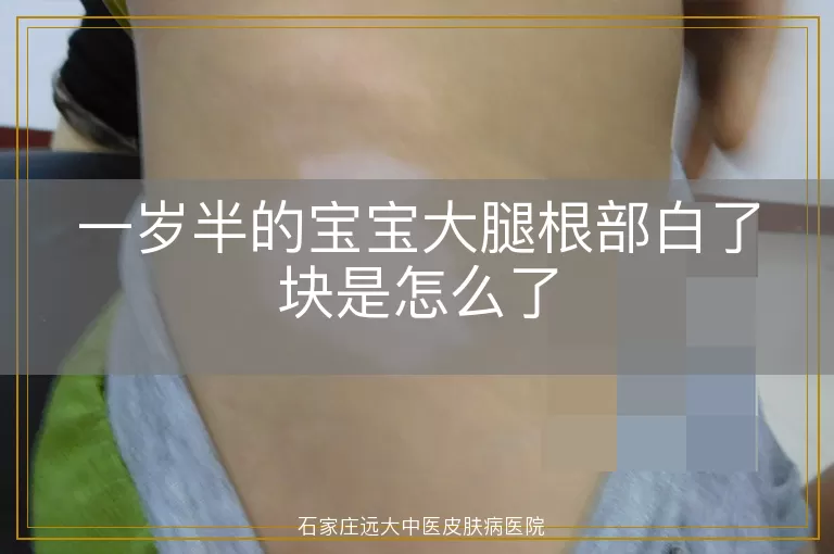 一岁半的宝宝大腿根部白了块是怎么了