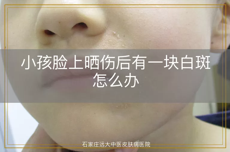 小孩脸上晒伤后有一块白斑怎么办