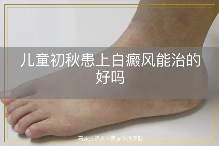 儿童初秋患上白癜风能治的好吗