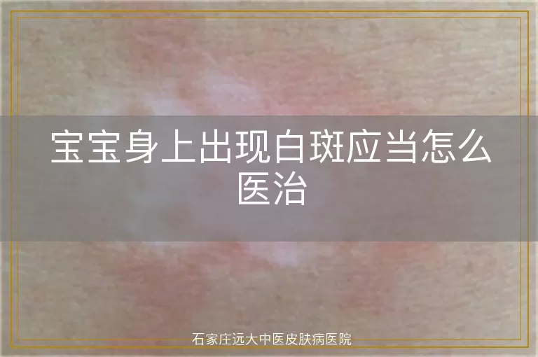 宝宝身上出现白斑应当怎么医治