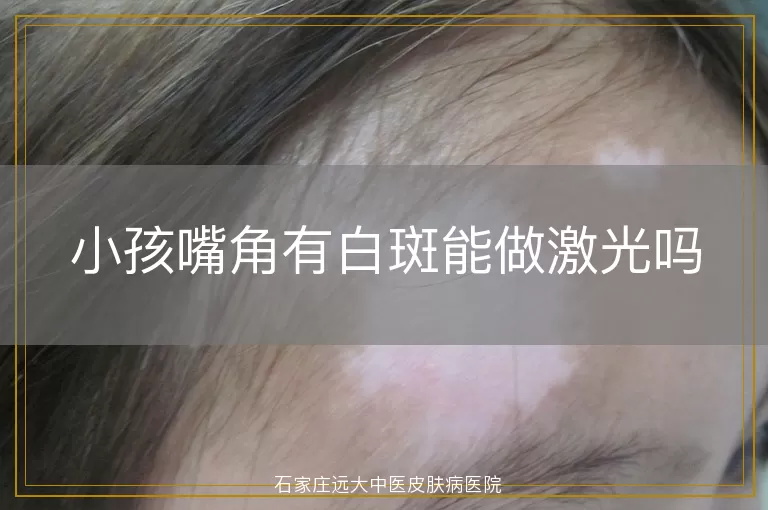小孩嘴角有白斑能做激光吗