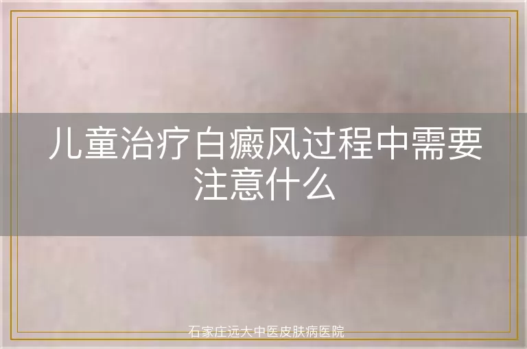 儿童治疗白癜风过程中需要注意什么