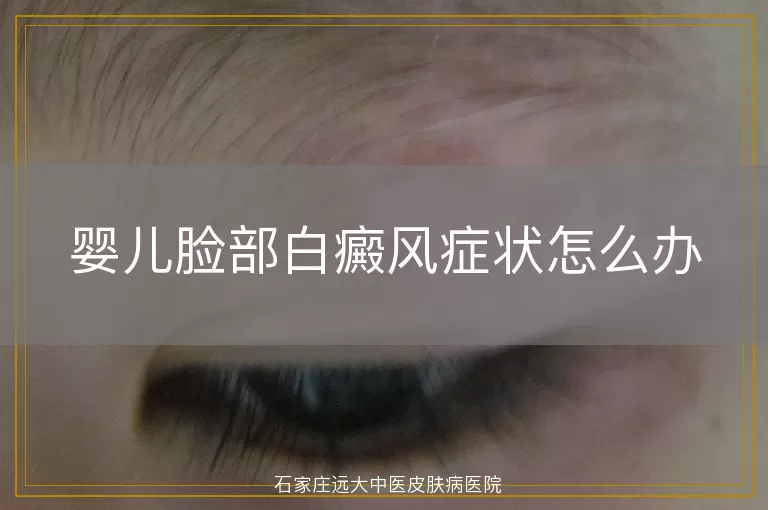 婴儿脸部白癜风症状怎么办