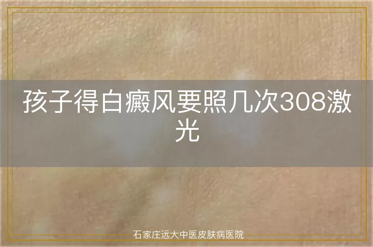 孩子得白癜风要照几次308激光