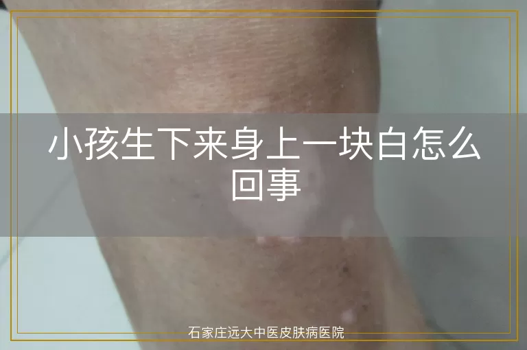 小孩生下来身上一块白怎么回事