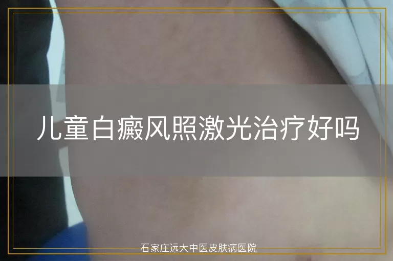 儿童白癜风照激光治疗好吗