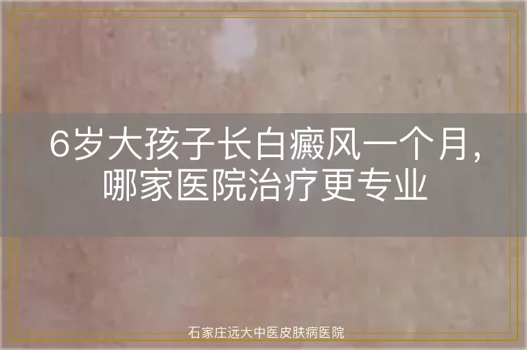 6岁大孩子长白癜风一个月，哪家医院治疗更专业
