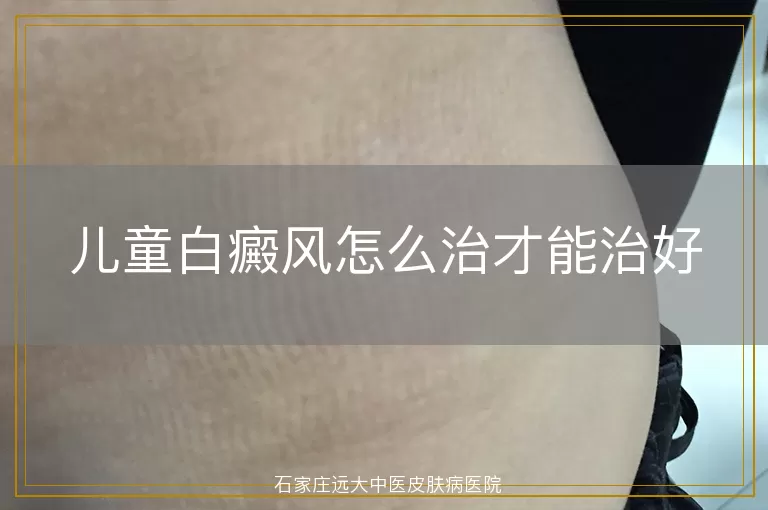 儿童白癜风怎么治才能治好
