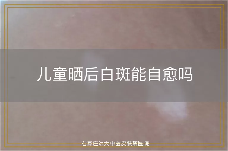 儿童晒后白斑能自愈吗