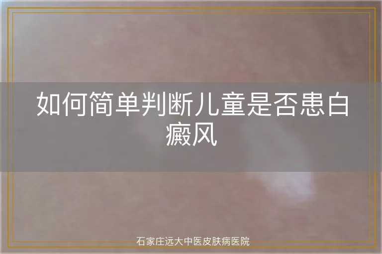 如何简单判断儿童是否患白癜风
