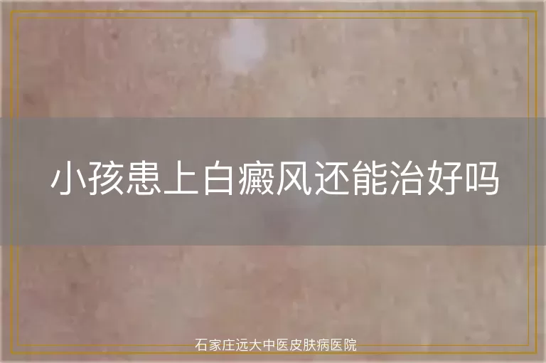 小孩患上白癜风还能治好吗