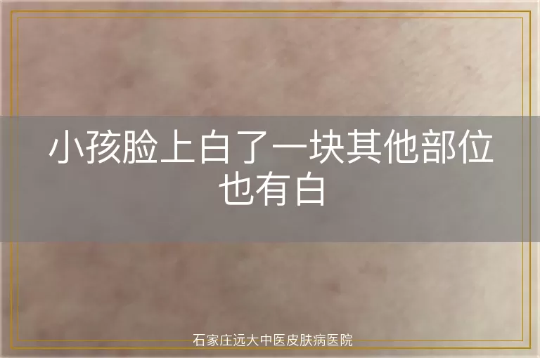 小孩脸上白了一块其他部位也有白