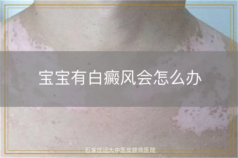 宝宝有白癜风会怎么办