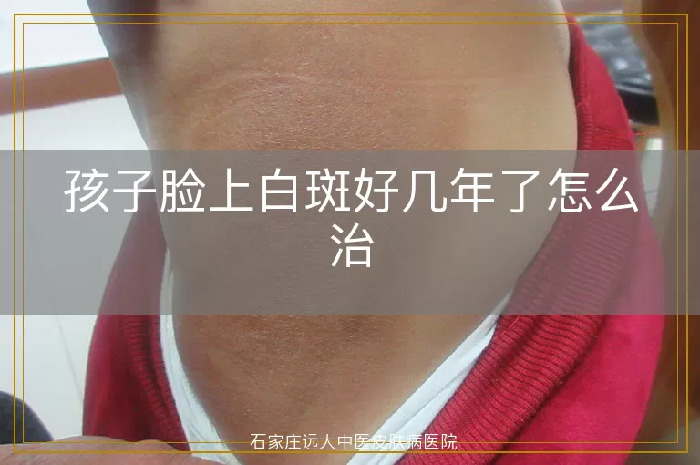 孩子脸上白斑好几年了怎么治