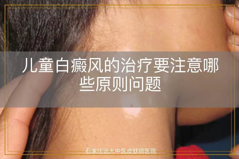 儿童白癜风的治疗要注意哪些原则问题