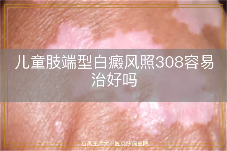 儿童肢端型白癜风照308容易治好吗